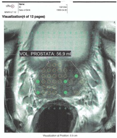 imagen_biopsia_por_fusión