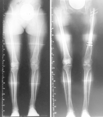 femoral-10