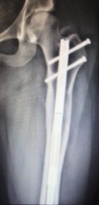 femoral-07-