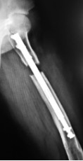 femoral-06-