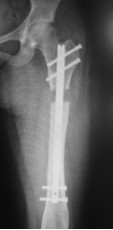 femoral-05-