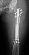 femoral-02