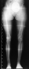 femoral-01