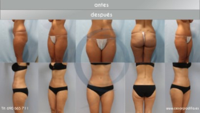 LIPOSUPCIÓN_MUSLOS_ANTESYDESPUES