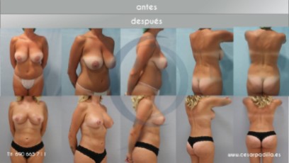 mastopexia_antesydespues