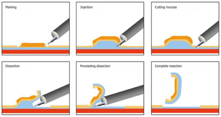 diseccion endoscópica submucosa2