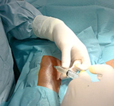 terapia regenerativa quironsalud marbella