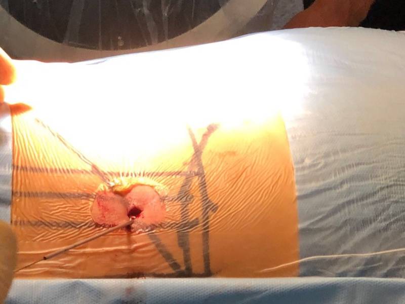 endoscopia_columna_quironsalud_marbella2