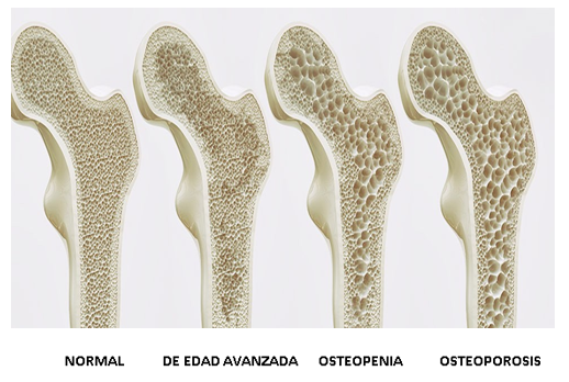 Osteoporosis