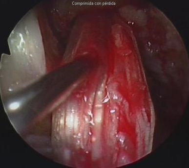 Intervención de rodilla