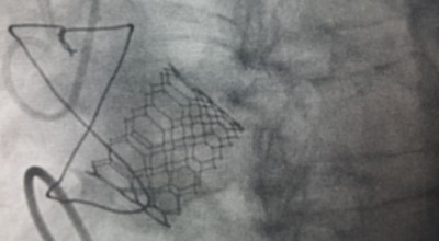 implante valvular