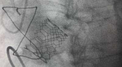 implante valvular