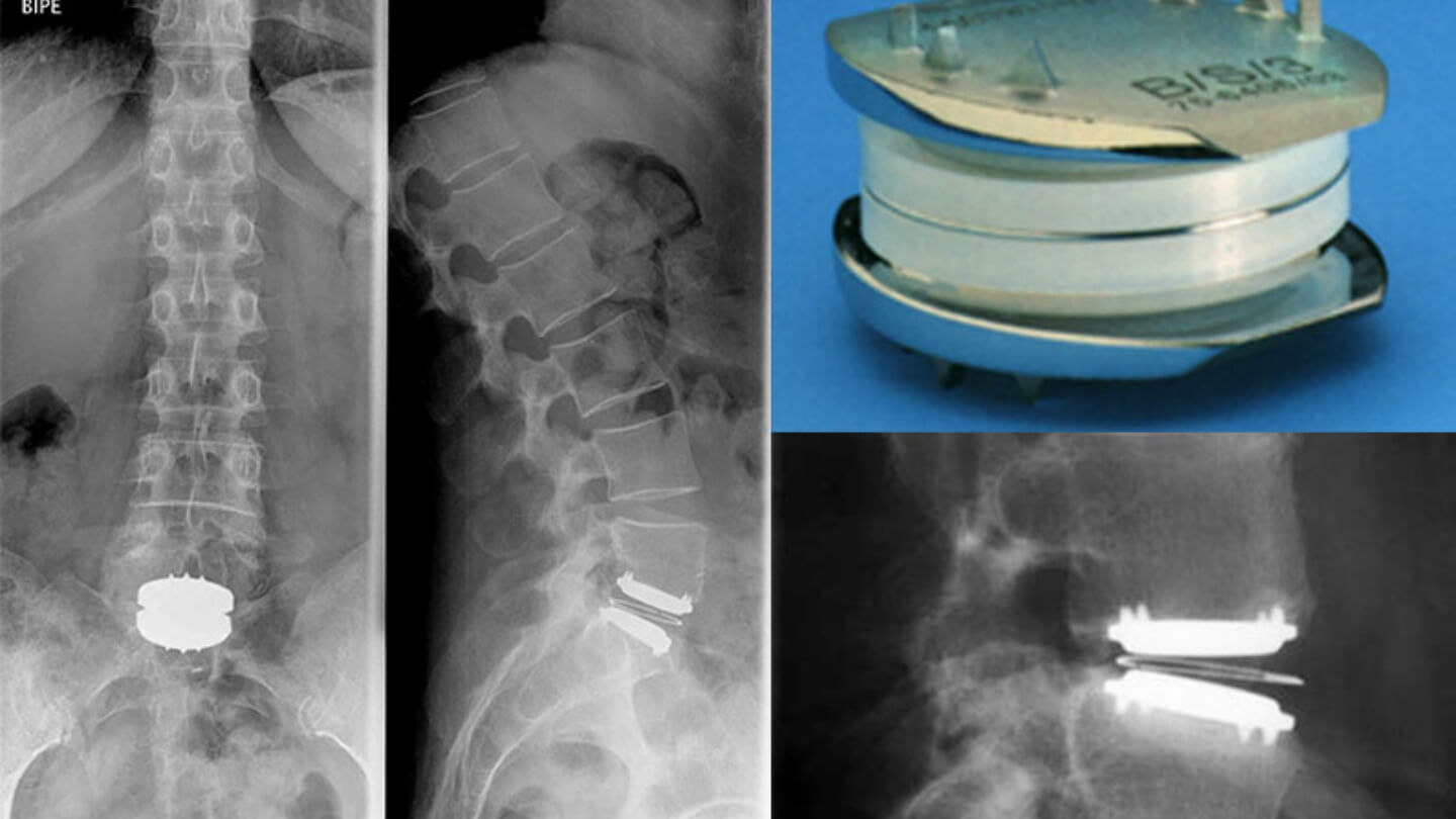 Protesis de disco lumbar