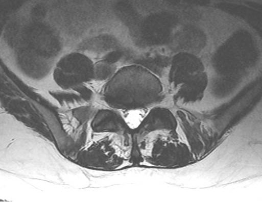 artrosis facetaria