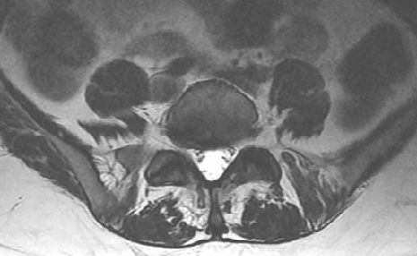 artrosis facetaria destacada