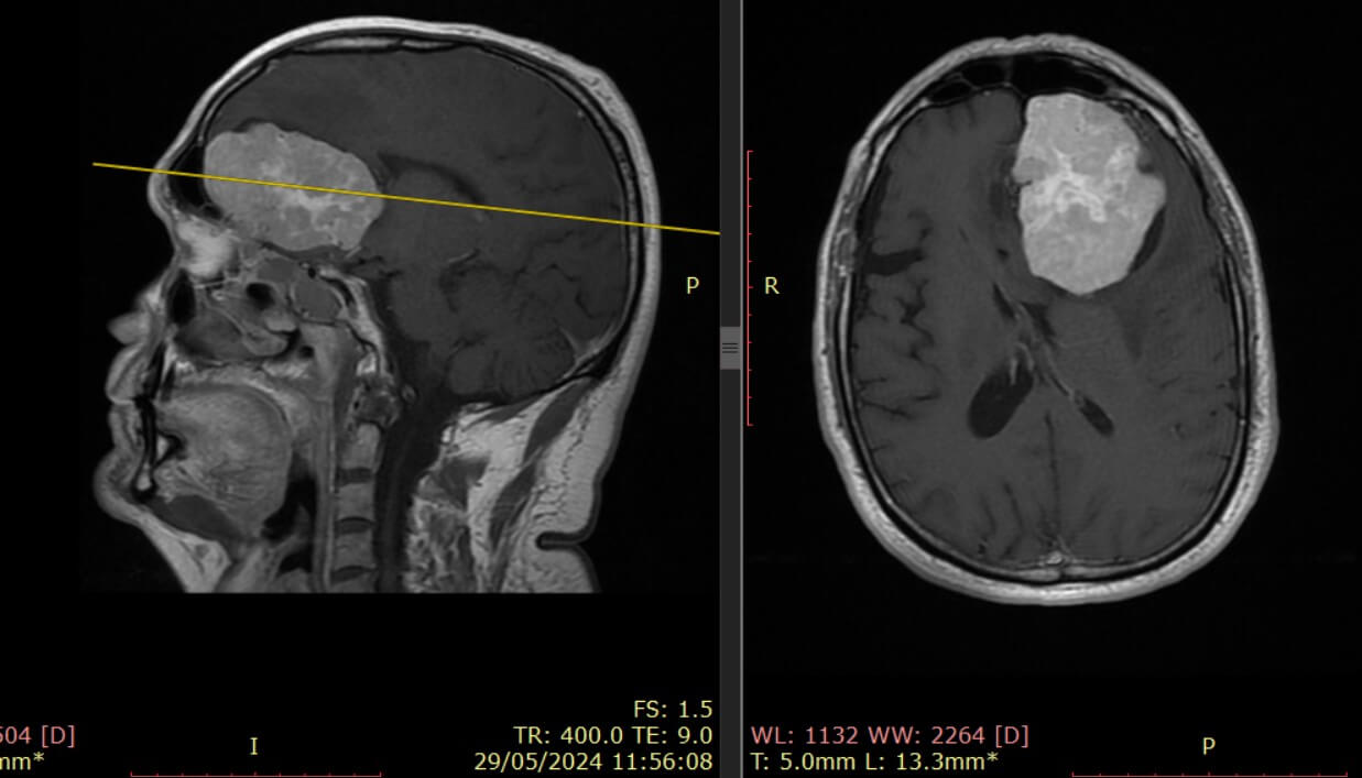 Meningioma. Tumor cerebral. Dr. Torales Hospital El Pilar Barcelona