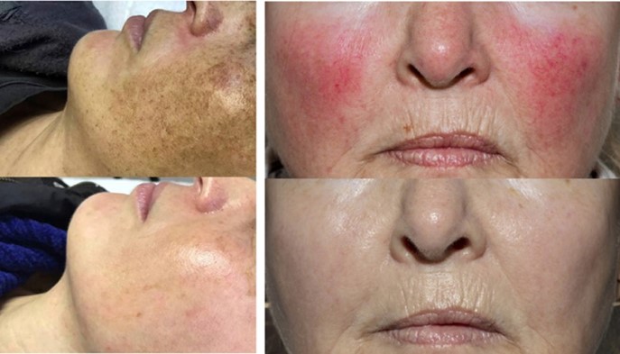 dermatologia fotoenvejecimiento