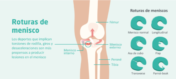 INFOGRAFIA ROTURAS DE MENISCO