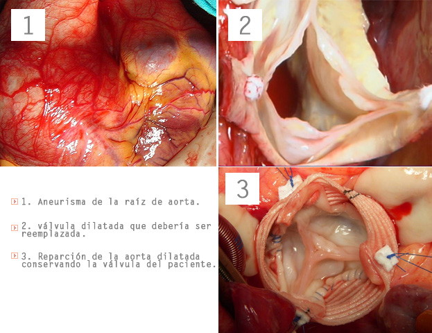 aneurisma_aorta_preservacion_valvula