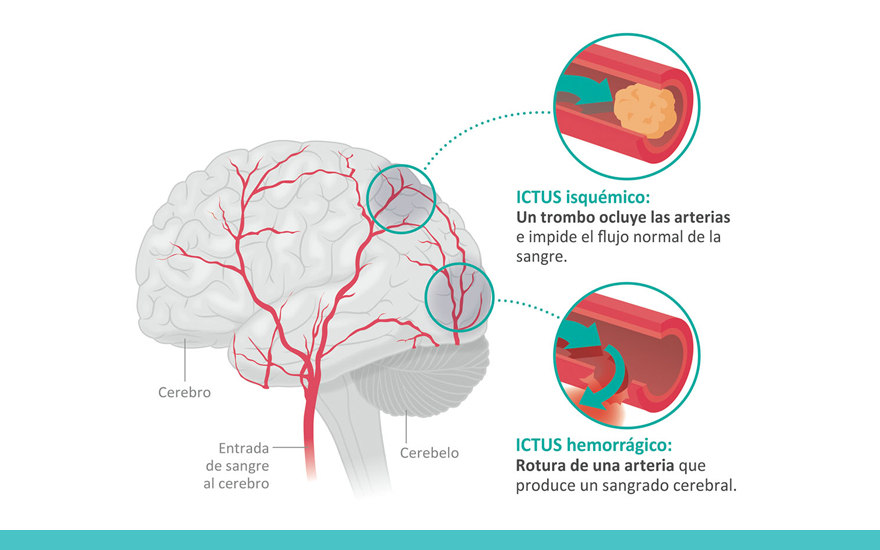 ictus