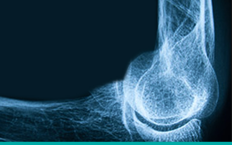 osteoporosis