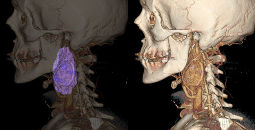 tumor_cervical
