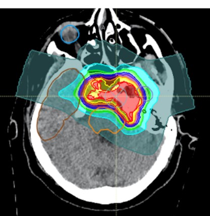 protonterapia 3