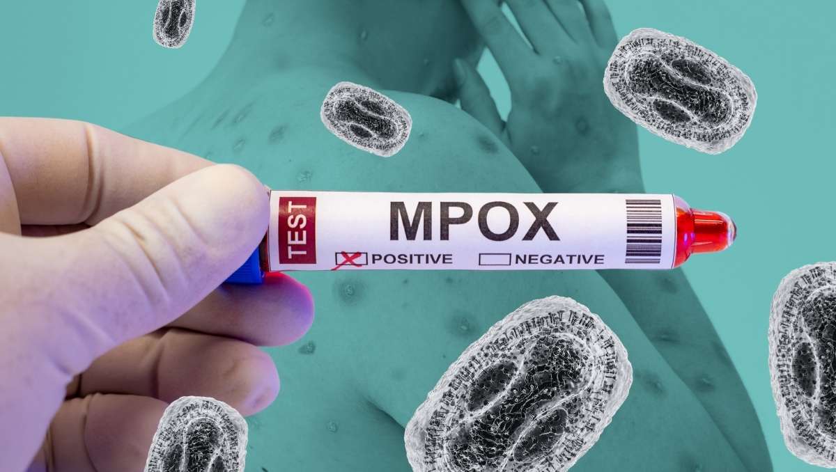 formas de contagio mpox viruela del mono prevencion