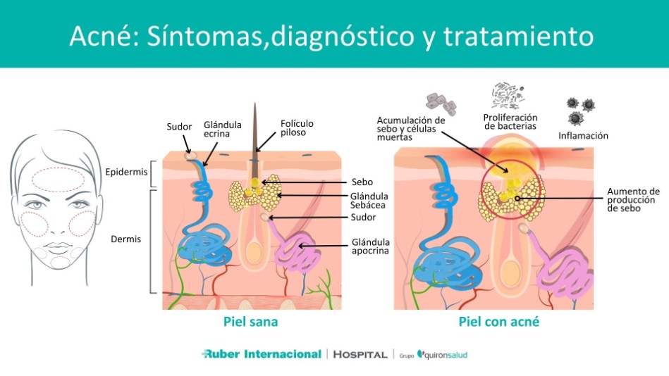 Qué es el acné y cuál es su tratamiento