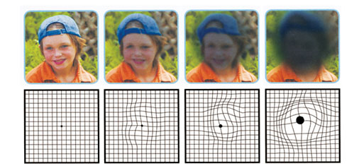 Degeneración Macular Asociada