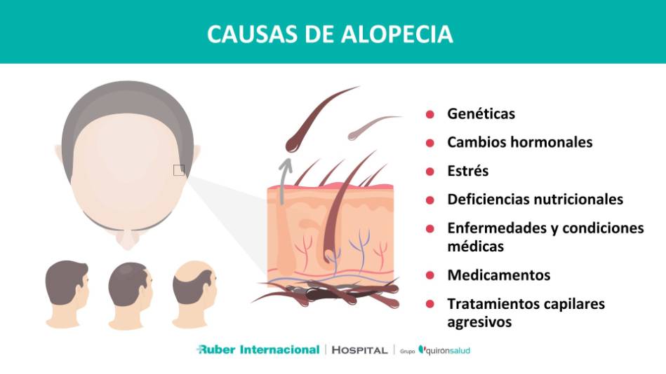 Caída del pelo o Alopecia. Causas y Tratamiento