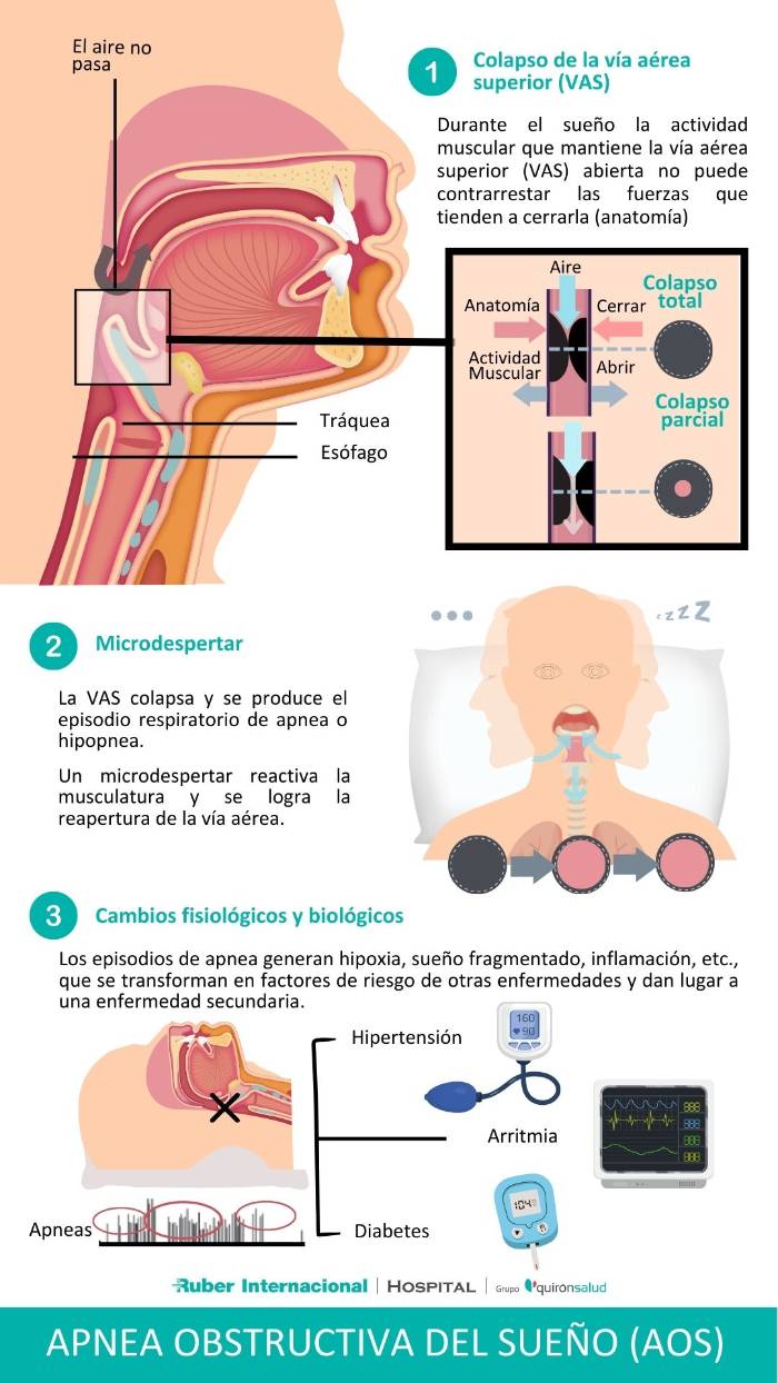 Qué es la apnea obstructiva del sueño Hospital Ruber Internacional