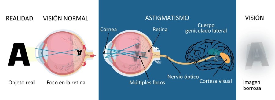 Astigmatismo