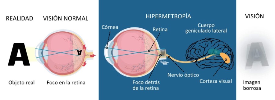 Hipermetropía