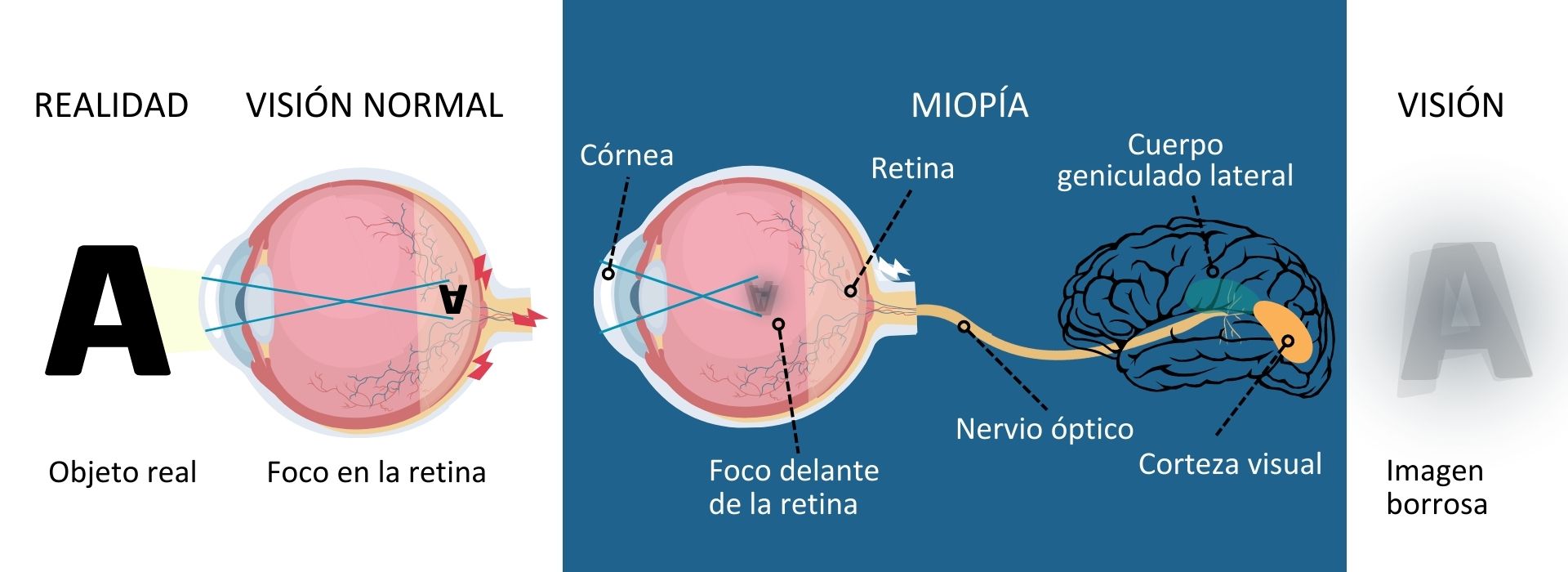 Miopía