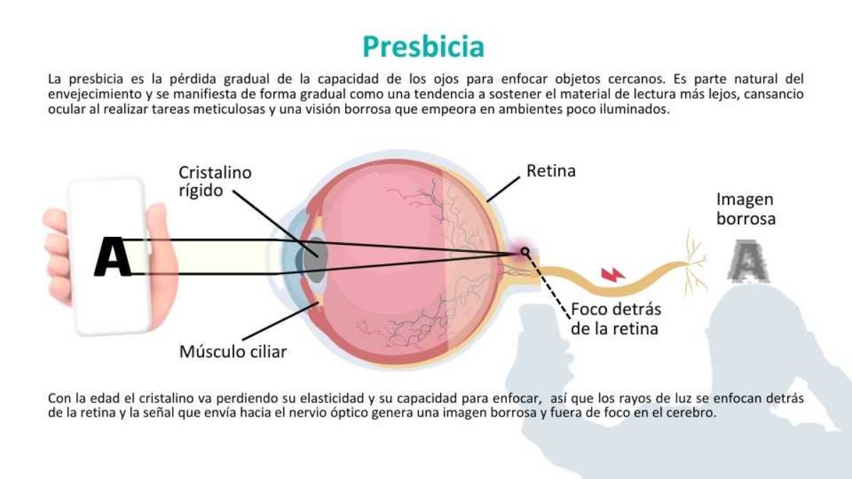 Presbicia Ruber Internacional Presbicia