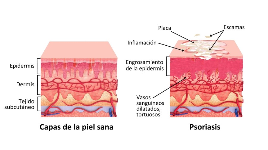Psoriasis Hospital Ruber Internacional