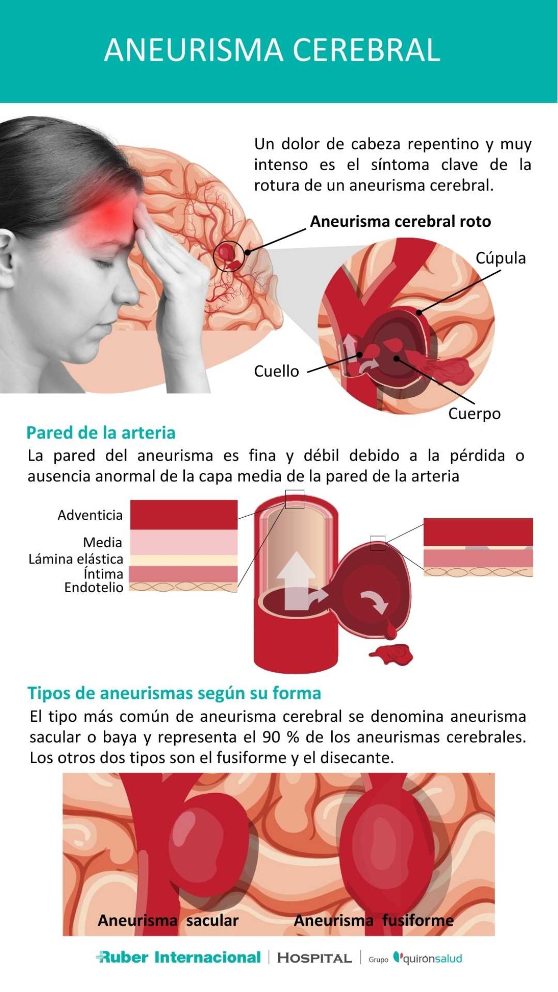 Aneurisma cerebral: Qué es y cómo se trata