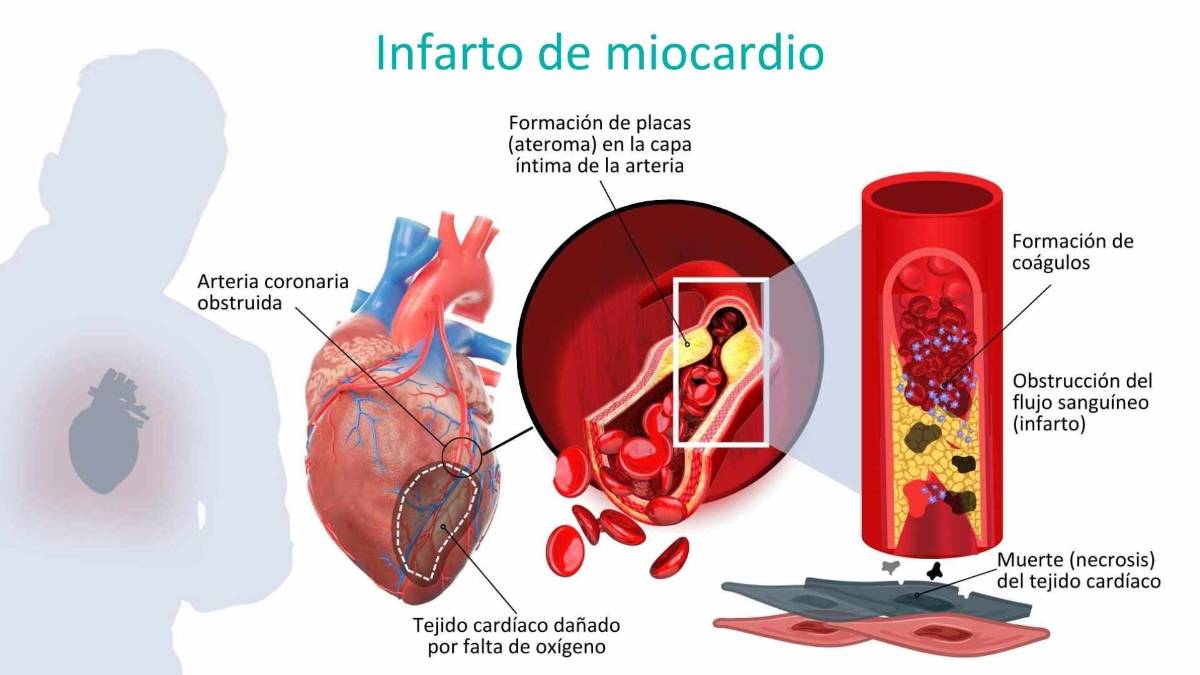 Infarto de miocardio Ruber internacional