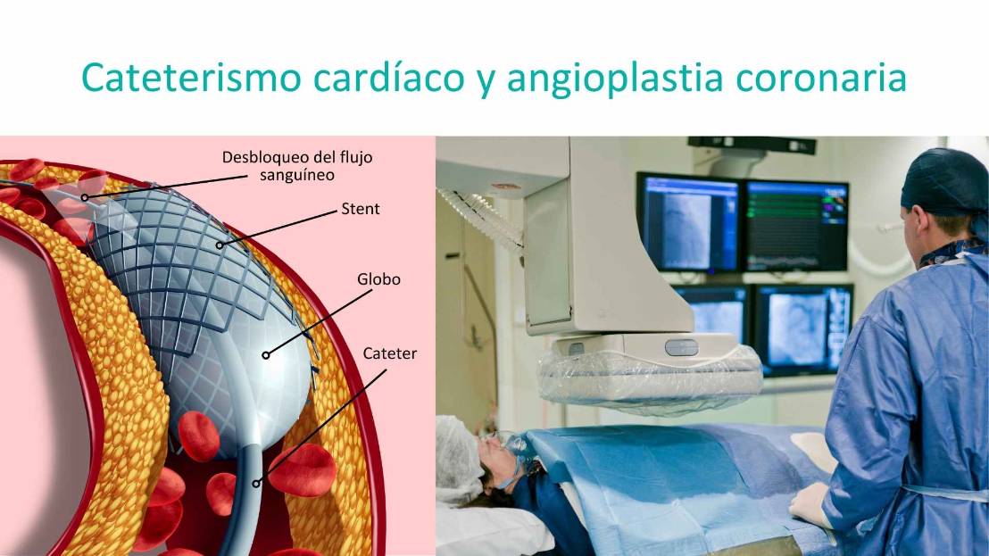 Infarto Stent Ruber Internacional