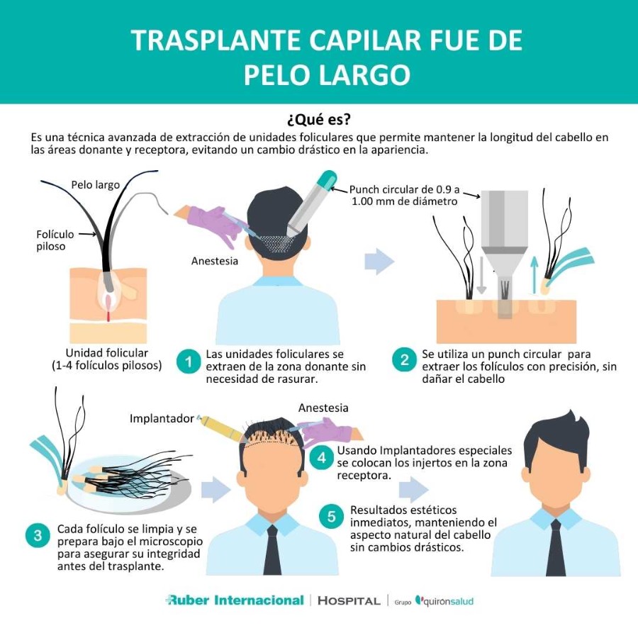 trasplante capilar fue pelo largo tecnica