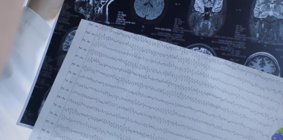 Cirugía de epilepsia