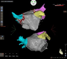 Sistema de navegación cardiaca CARTO