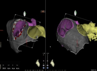 Sistema de navegación cardiaca CARTO