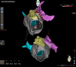 Sistema de navegación cardiaca CARTO