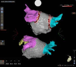 Sistema de navegación cardiaca CARTO