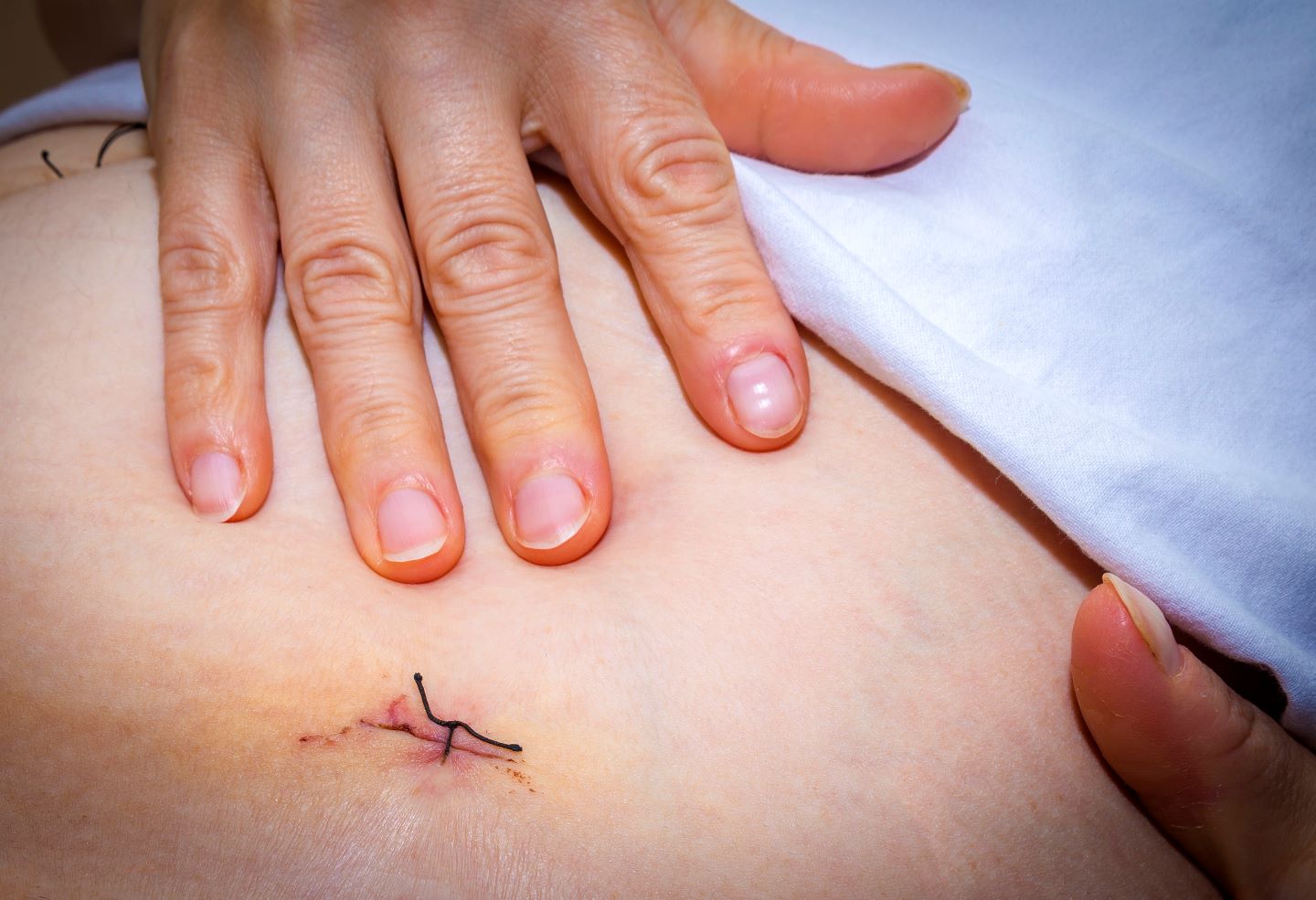 Cirugía endometriosis