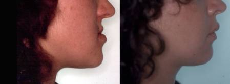 Cirugía ortognática