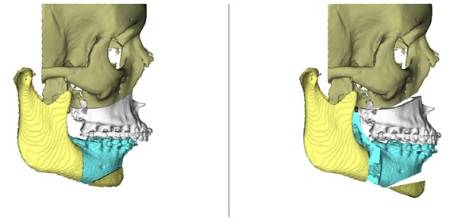 Cirugía ortognática
