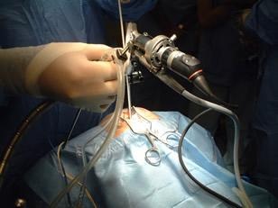 Hipofisectomía endoscópica